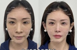 鼻尖整形恢复时间要多久？术后怎么护理？