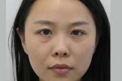 鼻子缩小整形手术效果怎么样？对比传统方法有哪些优势？