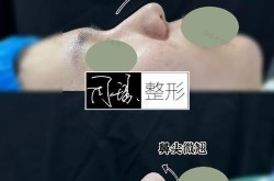 鼻尖整形方法有哪些？哪种方法效果最自然？