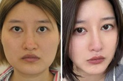 北京玻尿酸隆鼻效果如何？价格大概是多少？
