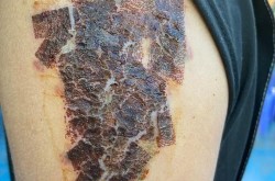 洗纹身的价格一般是多少？恢复期多久？