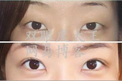 韩式定点双眼皮手术与传统手术相比有哪些优势？