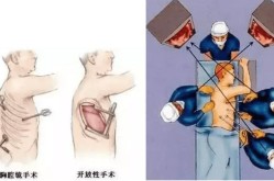 开胸手术是从哪里开刀的？术后恢复要注意什么？
