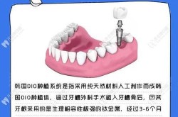 dio种植牙系统有什么优势？价格如何？