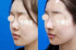 原辰整形做隆鼻效果好吗？有没有风险？