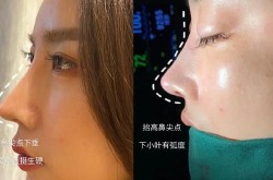 整容鼻子多少钱？如何选择合适的整形医院？