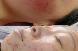 换肤手术真的能焕肤新生吗？换肤手术的副作用有哪些？