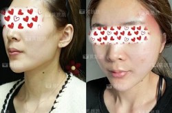 北京抽脂医院哪家好？手术安全和效果如何？