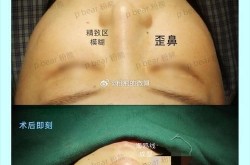 假体隆鼻能保持多久？会不会有移位的风险？