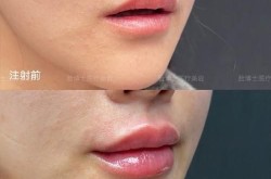 玻尿酸丰唇效果自然吗？有没有副作用？
