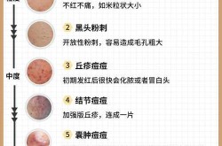 怎么去除痘疤最有效？有没有不反弹的方法？