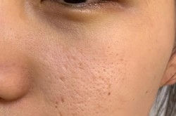 激光去痘坑要多少钱？效果可以维持多久？