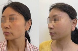 法令纹手术价格是多少？如何找到性价比高的手术？