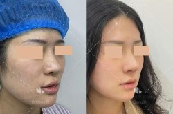 鼻头缩小手术前后的对比明显吗？有哪些风险？