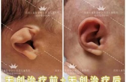 招风耳整形手术复杂吗？术后恢复期多久？