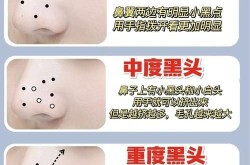 去黑头的小窍门有哪些？哪种最有效？