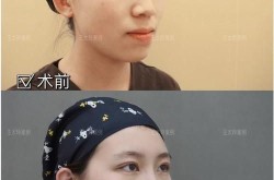北京哪家医院双眼皮手术做得自然？费用是多少？