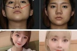 韩式隆鼻术与普通隆鼻有何区别？哪种更适合我？