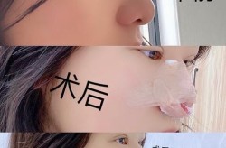 鼻头缩小术多少钱？手术复杂吗？