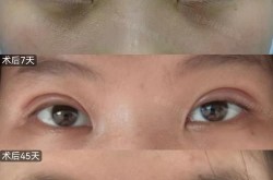 广州双眼皮手术哪家医院技术好？求推荐！