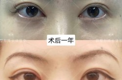眼部整形术哪里做得好？怎样避免手术风险？