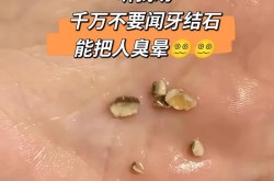 超声波洁牙多少钱一次？和普通洗牙有什么区别？