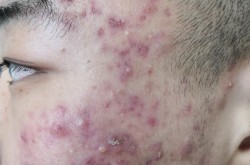 激光痤疮治疗价格贵吗？与传统治疗相比的优势？