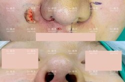 鼻翼上提手术效果如何？有哪些风险？