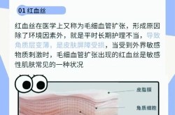 红血丝怎么祛除？激光和药物哪个更有效？