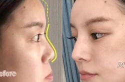 隆鼻手术需要多少钱？效果可以维持多久？