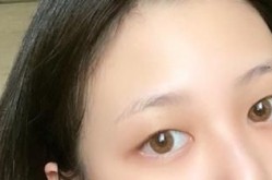 割双眼皮整形医院如何选择？有没有不为人知的风险？