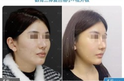 颧骨高的女性如何通过整形改善脸型？
