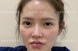 北京硅胶隆鼻效果自然吗？硅胶隆鼻与自体脂肪隆鼻对比？