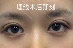 单眼皮埋线手术安全吗？有哪些需要注意的问题？