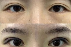 郑州丽天整形医院做双眼皮怎么样？求案例！