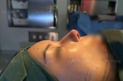 低鼻尖整形手术多少钱？效果明显吗？
