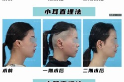 耳垂畸形矫正手术安全吗？恢复期多久？