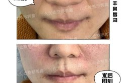 注射丰鼻唇沟效果如何？有没有副作用？