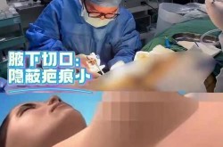 假体丰胸取出手术需要注意什么？会留下疤痕吗？