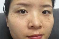 激光去老年斑的费用是多少？效果好不好？