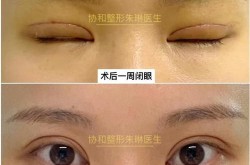 北京医院双眼皮手术哪家好？恢复期多久？