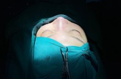 鼻部整形美容手术有哪些风险？如何避免术后并发症？