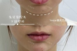 下巴整形手术有哪些方法？哪种最自然？