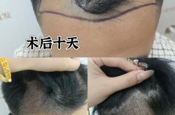移植毛发效果图看起来自然吗？手术过程复杂吗？