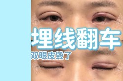 埋线双眼皮手术过程是怎样的？痛不痛？