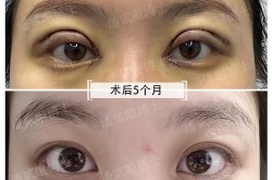 开内眼角后遗症有哪些？如何避免？