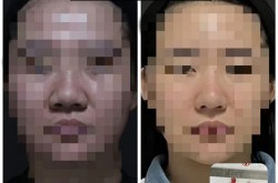鼻头缩小手术需要多少钱？恢复期要多久？