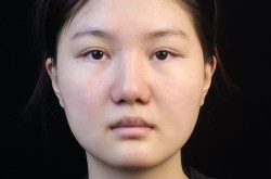缩小鼻翼手术需要多少钱？术后恢复期长吗？