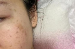 激光治疗黄褐斑效果如何？有没有副作用？
