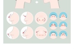 小鼻翼整形要多少钱？术后护理需要注意什么？